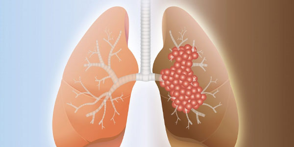 Pulmonary Fibrosis treatment in Hyderabad