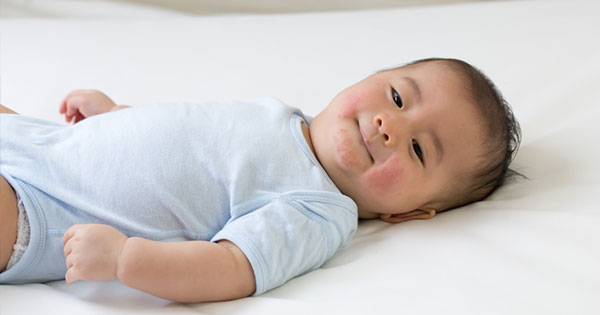 Common Allergies in Children