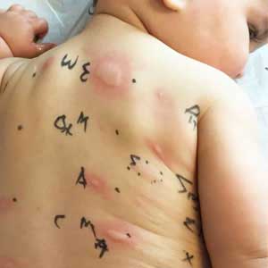 Children Allergy Testing in Hyderabad