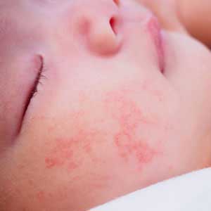 Children Atopic Dermatitis Treatment in Hyderabad