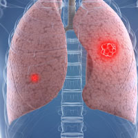 pleural disease treatment