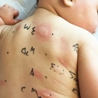 Allergy Testing in Kukatpally