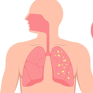 Connective tissue diseases related to ILD