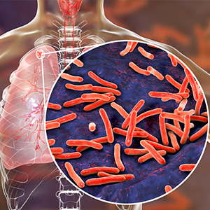 Tuberculosis Treatment in Hyderabad