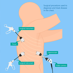 Thoracoscopy in Hyderabad