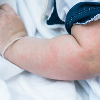 Children Urticaria Treatment in Hyderabad